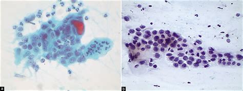 The Pap smear in inflammation and repair .